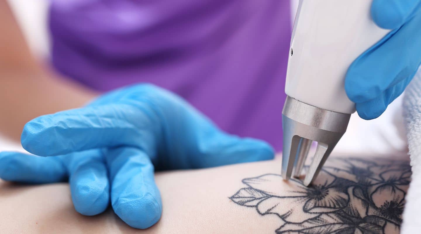 5 Types of Tattoo Removal Methods