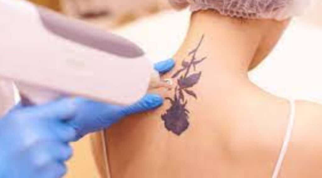Tattoo Laser Removal featured image