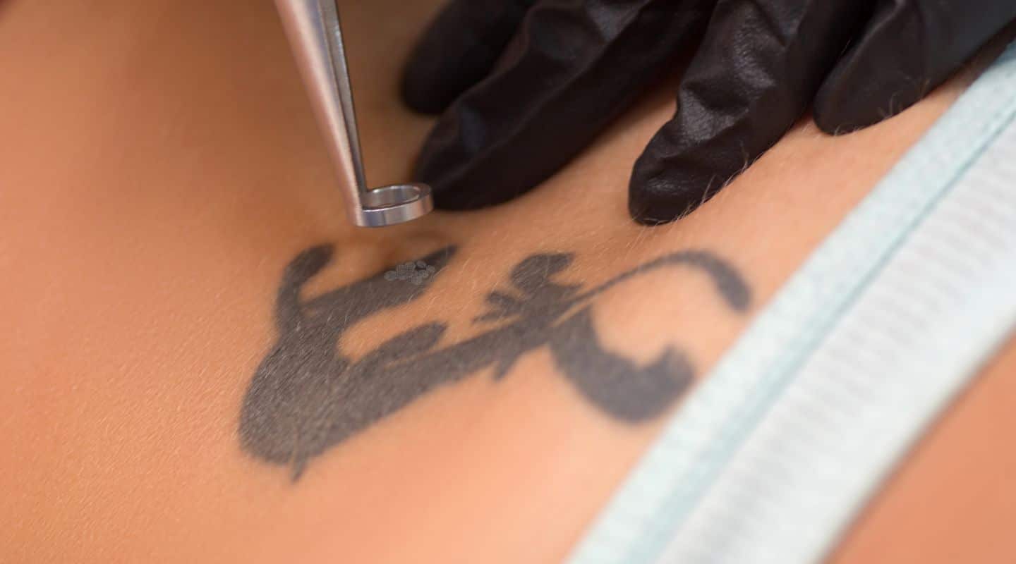 What To Expect After Tattoo Removal