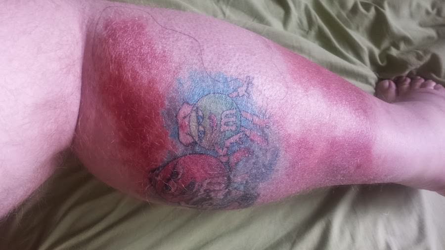 Infection Risks of Tattooing