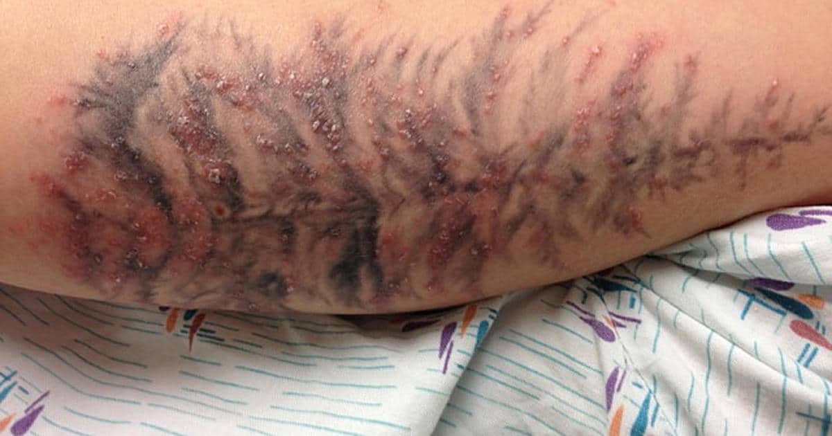 infection of tattooing